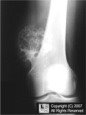Osteochondroma
